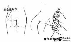 肌内注射法