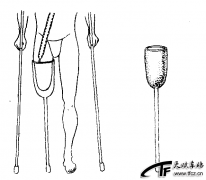 截肢病人的护理